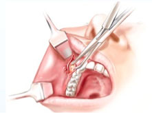 cirurgia plastica das bochechas
