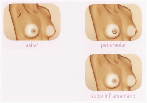protese mamaria aumento de mamas